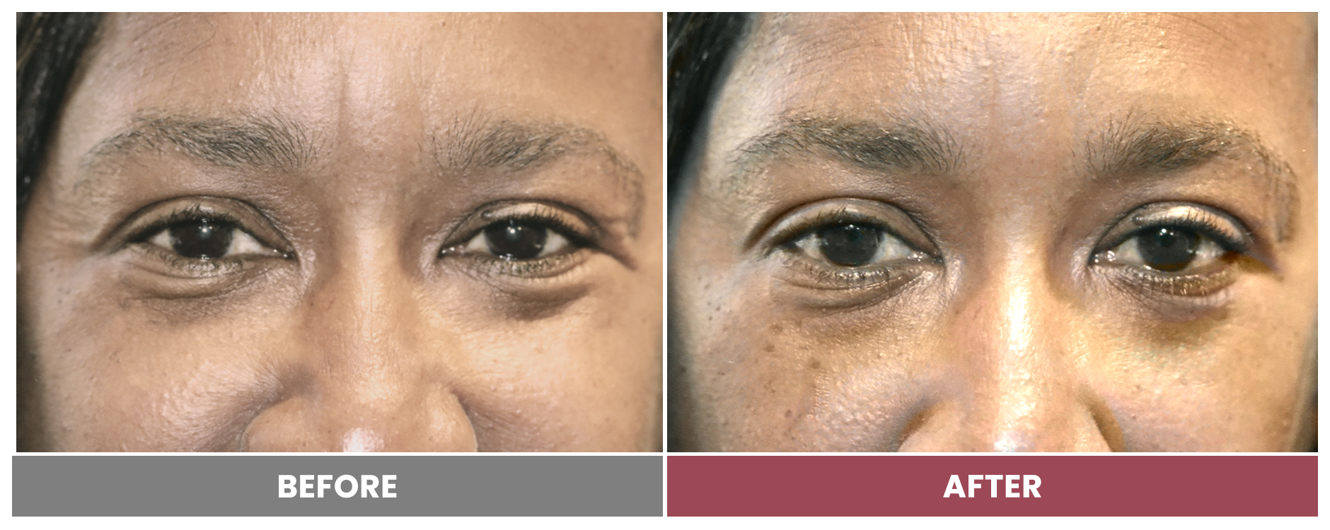 BOTOX FOR WRINKLES & BROW LIFT - Case 14